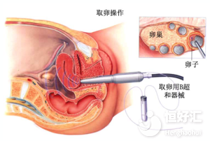 試管嬰兒取卵時疼嗎?看完這個你就安心了