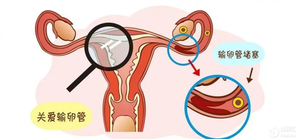 女性輸卵管堵塞的癥狀是什么？