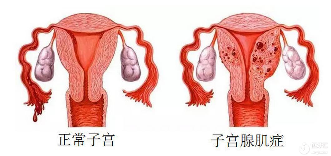 腺肌癥對(duì)懷孕的影響，你不會(huì)還不知道吧?